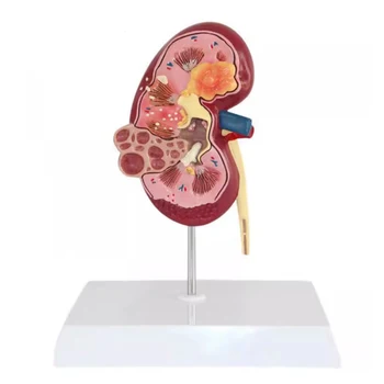 Ledvične Bolezni Anatomski Model Človeškega Telesa, Organ Anatomija Obolelih Ledvic za Zdravnike Office z Izobraževalnimi Dobave